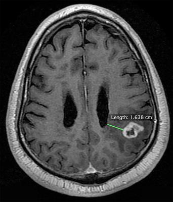 Glioblastoma Distance From the Subventricular Neural Stem Cell Niche Does Not Correlate With Survival